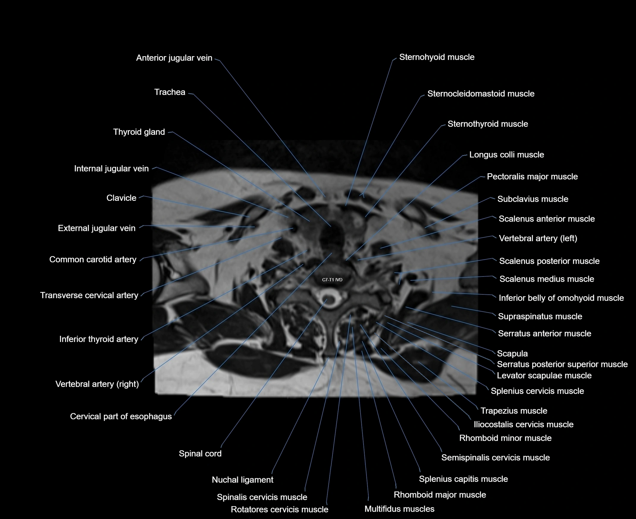 MRI Neck 3D labelled cross section anatomy axial 3t image-00001-00080.webp